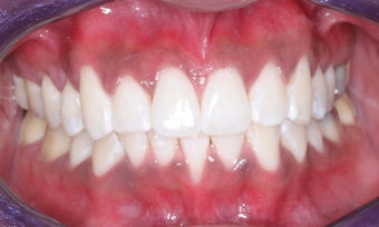 Whitening and Invisalign