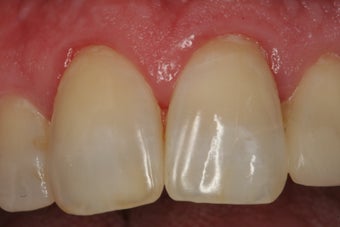 Internal Bleaching of Non-Vital Tooth