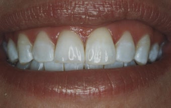 Teeth Whitening