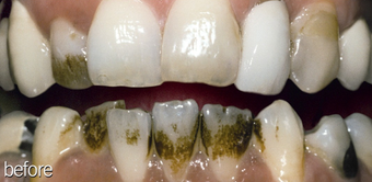 Teeth Whitening Smoking