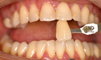 Deep bleaching