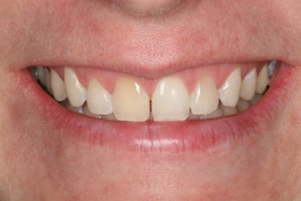 Whitening a single anterior tooth