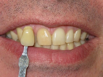 Whitening bleach trays