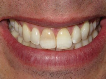 Internal Deep Bleaching