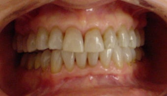 whitening tetracycline stained teeth