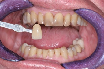 Whitening