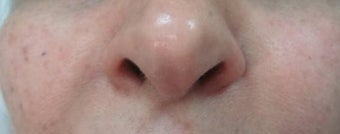 Nasolabial Injection
