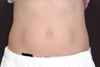 Thermage for Body - (Tummy/Abdomen)