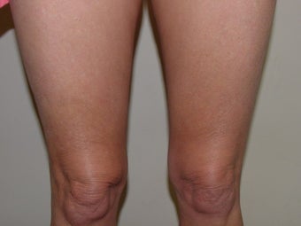 Thermage of kneees before and after