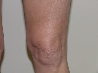 Thermage of knee before