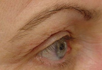 Thermage of eyes before and after