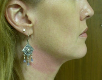 Thermage Treatment