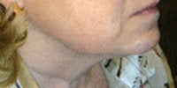 Thermage