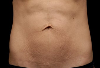 Body contouring