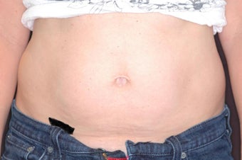 Thermage for Body - (Tummy/Abdomen)