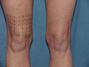 Thermage of kneees before and after