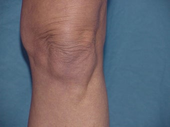 Thermage of knee before