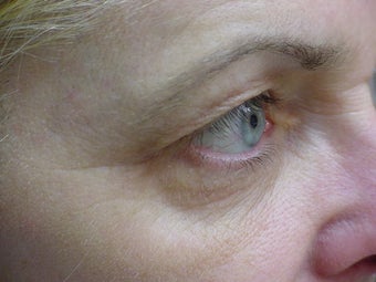 Thermage of eyes