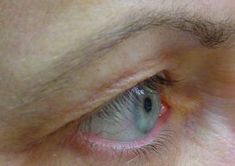 Thermage of eyes before and after