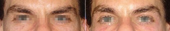 Eye "lift" with Thermage
