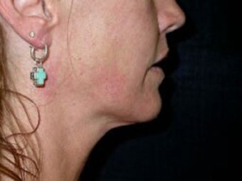 Thermage Treatment
