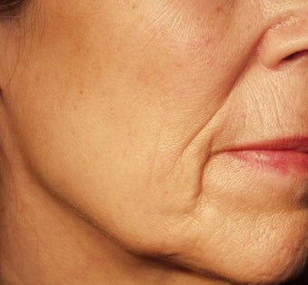 Thermage