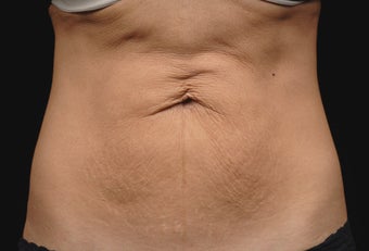 Body contouring