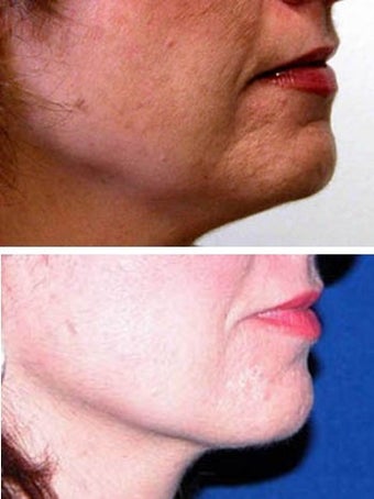 Thermage to jaw line and chin