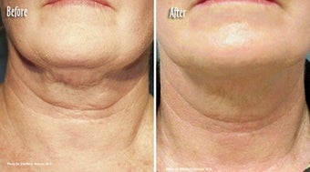  Thermage to Neck, chin  and jaw line