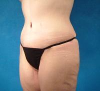 Thigh Lift