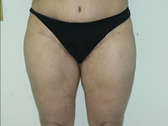 Inner thigh lift