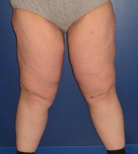 Thigh Lift (Thighplasty)
