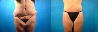 Lower Body Lift and Inner Thigh Lift