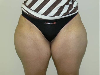 Inner thigh lift