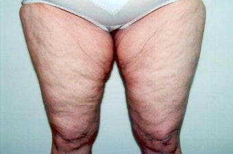 Medial Thigh Lift