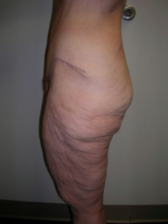 Thigh Lift