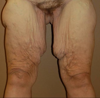 thigh lift