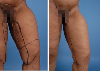 Thighplasty
