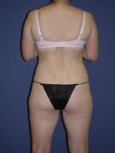 Thigh Lift