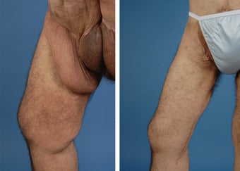 Thighplasty