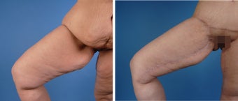 Thighplasty