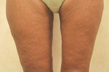 Medial (Inner) Thigh Lift