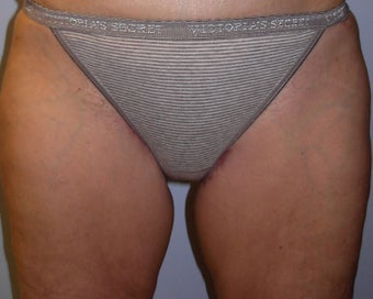 Thigh Lift