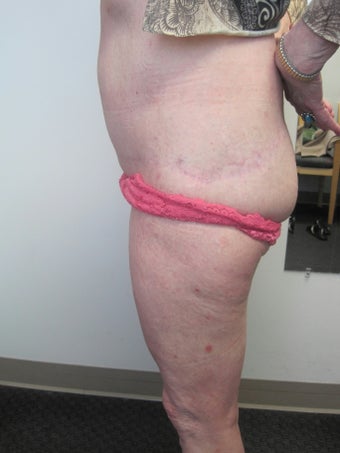 Lateral  Thigh Lift