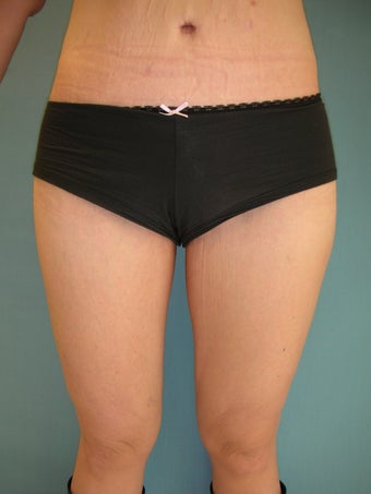 thighlift