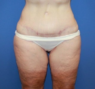 Inner thigh lift