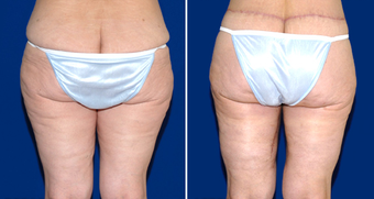 Thigh Lift