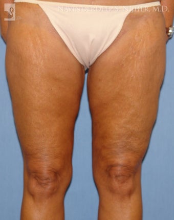 Thigh Lift