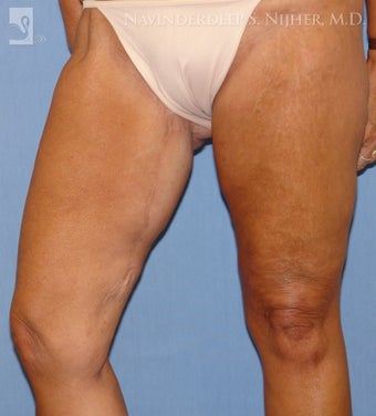 Thigh Lift