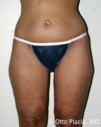 Thigh and Buttock Lift
